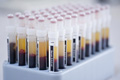 Общий анализ мочи норма лейкоциты в крови thumbnail