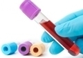 При анализе крови в биоматериале обнаружен сгусток крови thumbnail